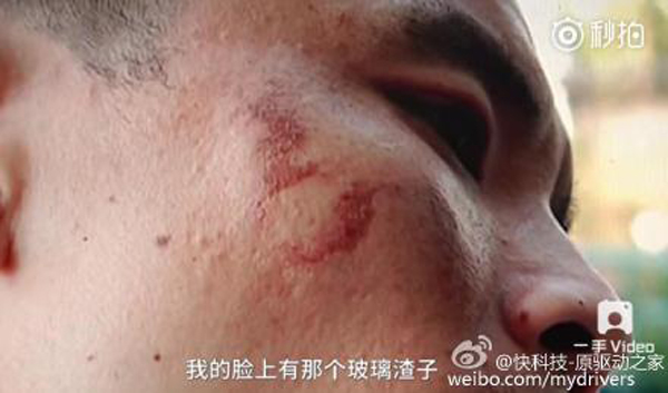 男子手部和臉部不同程度被炸傷。